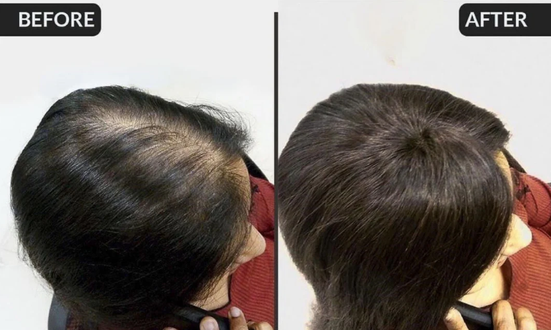 Best Toppers for Womens Hair Loss A Complete Guide to Choosing the Right One